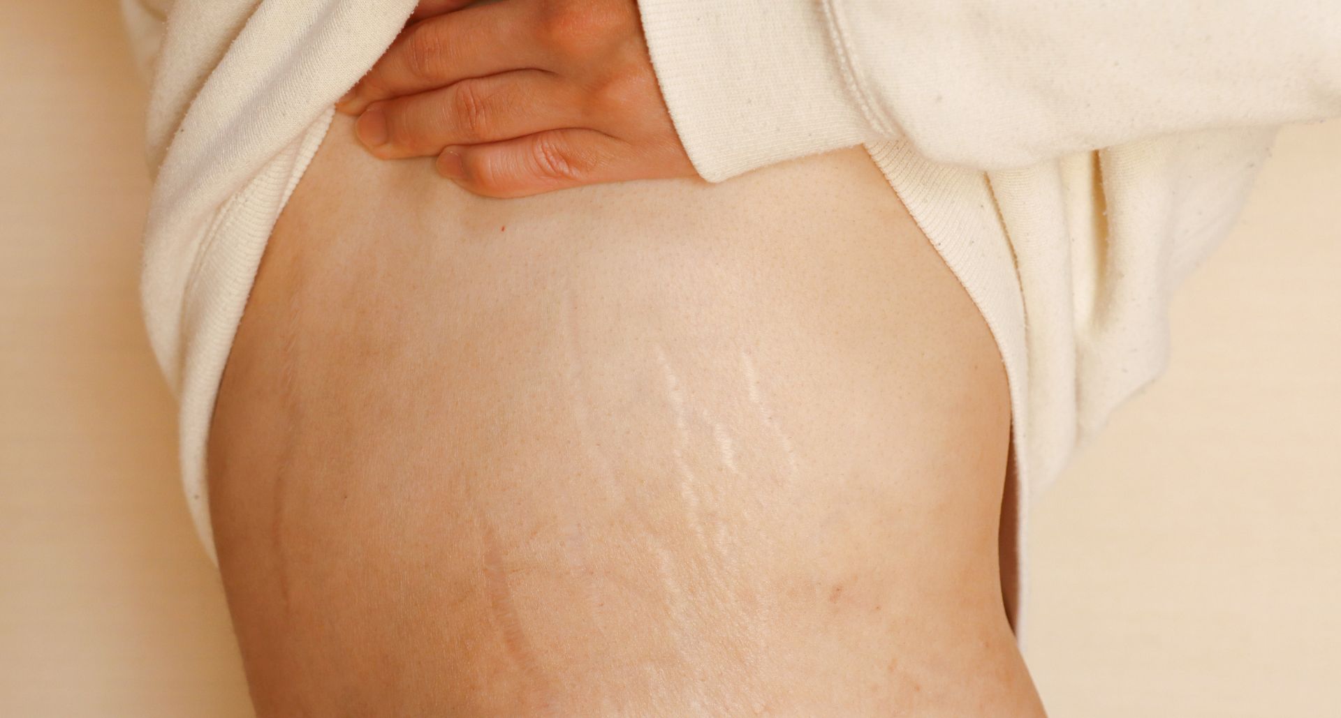 Stretch Marks Treatment Laser